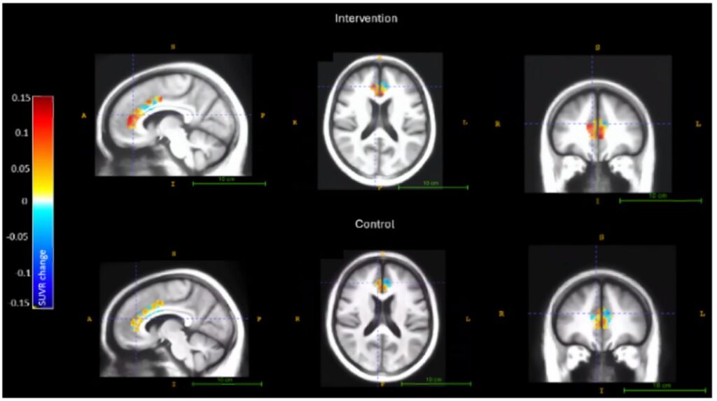 Acetilcolina, buon training cognitivo ne aumenta i livelli