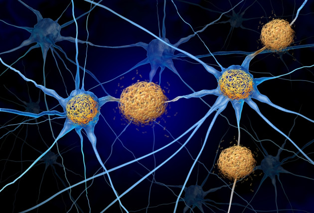 L’Alzheimer deriva da antiche difese antivirali?